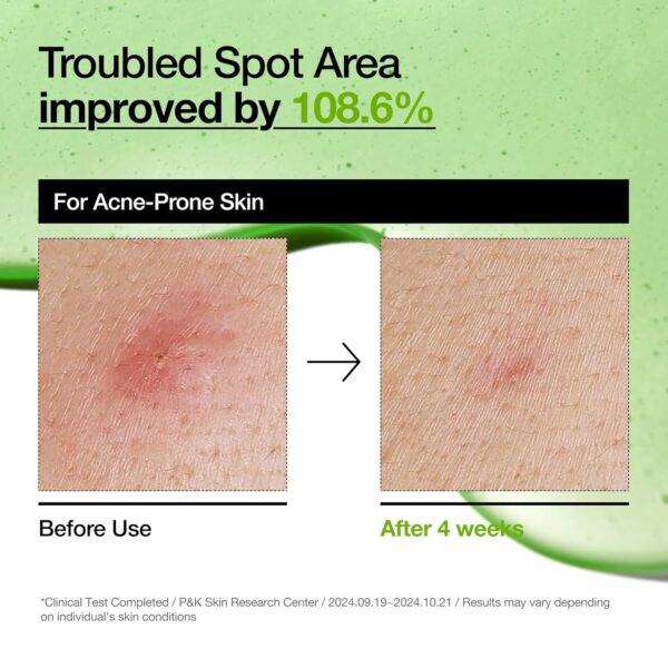 Anua - Azelaic Acid 10 + Hyaluron Serum | Troubled Spot Area improved by 108.6% | For Acne-Prone Skin | * Clinical Test Completed at P&K Skin Research Center on 2024.09.19~2024.10.21. Results may vary depending on individual's skin conditions.