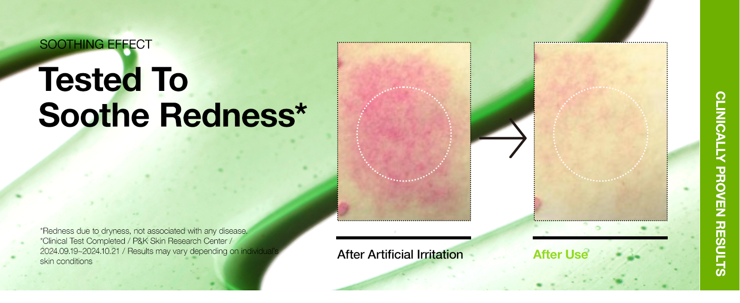 Anua - Azelaic Acid 10 + Hyaluron Serum | Soothing Effect | Tested to Soothe Redness* | * Redness due to dryness, not associated with any disease. | * Clinical Test Completed at P&K Skin Research Center on 2024.09.19~2024.10.21. Results may vary depending on individual's skin conditions.