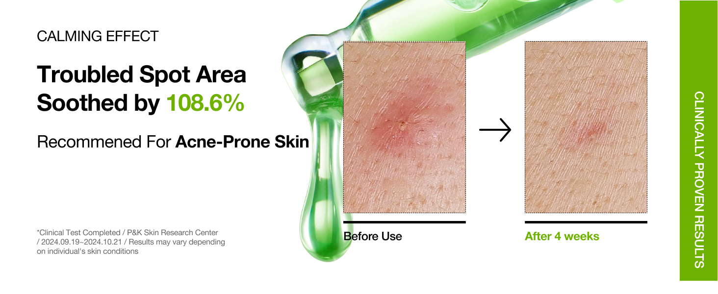 Anua - Azelaic Acid 10 + Hyaluron Serum | Calming Effect | Troubled Spot Area Soothed by 108.6% | Recommended for Acne-Prone Skin. | * Clinical Test Completed at P&K Skin Research Center on 2024.09.19~2024.10.21. Results may vary depending on individual's skin conditions.