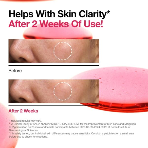 Anua - Niacinamide 10 TXA 4 Serum | Helps with Skin Clarity* | After 2 weeks of use! | * Individual results may vary. | * A Clinical Study of ANUA NIACINAMIDE 10 TXA SERUM for the Improvement of Skin Tone and Mitigation of Pigmentation on 23 male and female participants between 2023.08.09~2024.09.26 at Korea Institute of Dermatological Sciences. | * Is is safely tested, but individual skin differences may cause sensitivity. Conduct a patch test on a small area before use to check for reactions.