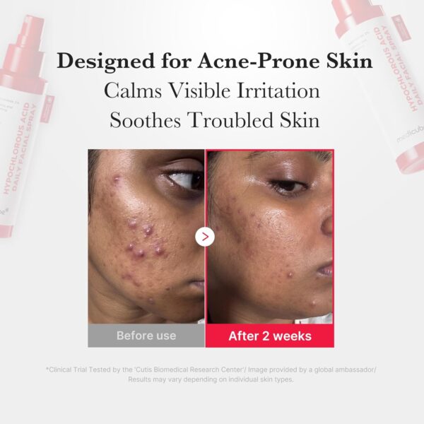Medicube - Hypochlorous Acid Daily Facial Spray | Designed for Acne-Prone Skin | Calms Visible Irritation | Soothes Troubled Skin | * Clinical Trial Tested by the 'Cutis Biomedical Research Center'. Image provided by a global ambassador. Results may vary depending on individual skin types.